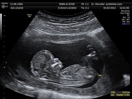 What happens at your 12-week ultrasound appointment?
